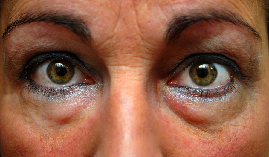 The-Cause-of-Baggy-Eyes-and-Treatment-Methods
